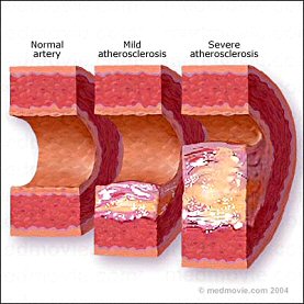 arteriosclerosi